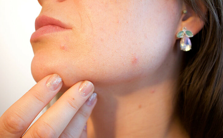 Hoe verzorg je een gevoelige huid?